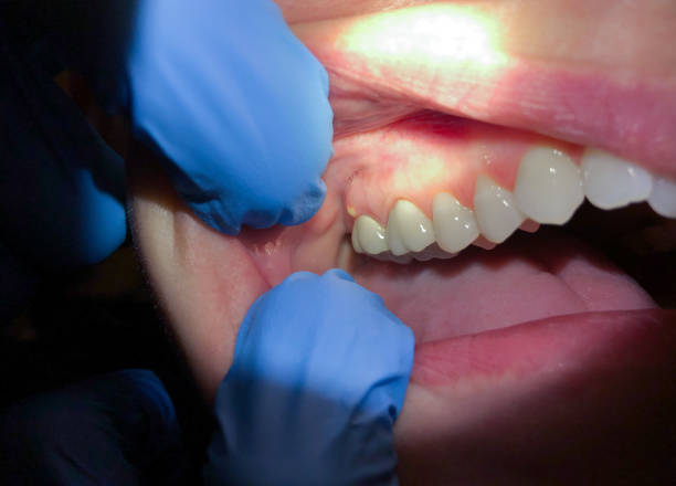 Best Emergency Dentist for Lost Fillings or Crowns in Black Diamond, WA
