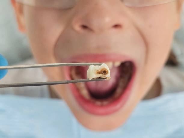 Best Emergency Root Canal Treatment in Black Diamond, WA